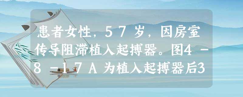 患者女性,57岁,因房室传导阻滞植入起搏器。图4-8-17A为植入起搏器后3个月复查的心电图,图4-8-17B为植入起搏器后6个月复查的心电图。 图4-8-17A提示 患者女性,57岁,因房室传导阻滞植入起搏器。图4-8-17A为植入起搏器后3个月复查的心电图,图4-8-17B为植入起搏器后6个月复查的心电图。 图4-8-17A提示