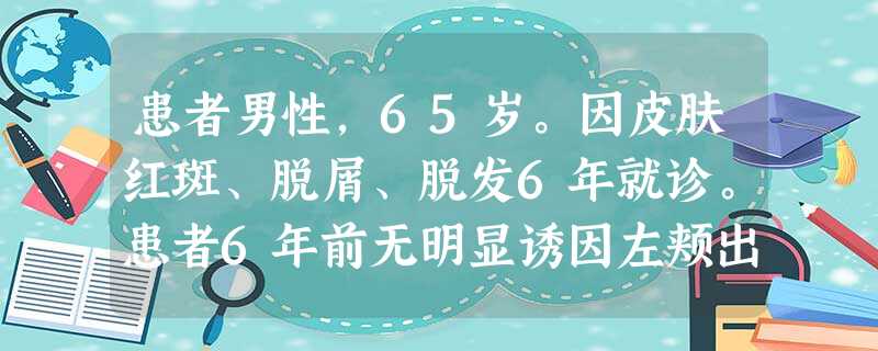 患者男性,65岁。因皮肤红斑、脱屑、脱发6年就诊。患者6年前无明显诱因左颊出现红丘疹,少量脱屑,无痛 患者男性,65岁。因皮肤红斑、脱屑、脱发6年就诊。患者6年前无明显诱因左颊出现红丘疹,少量脱屑,无痛
