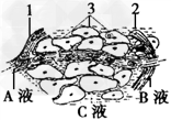 下图是人体肝脏局部内环境示意图,下列叙述正确的是①某人长期摄入蛋白质过少,会引起C液增加 ②结构2的细胞所处的内环境为淋巴 ③A液中的O2浓度总是比 下图是人体肝脏局部内环境示意图,下列叙述正确的是①某人长期摄入蛋白质过少,会引起C液增加 ②结构2的细胞所处的内环境为淋巴 ③A液中的O2浓度总是比