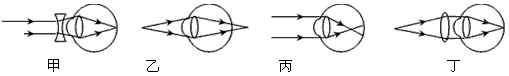 6月6日为全国“爱眼日”。我市很多学生不注意用眼保健,以致近视眼越来越多,近视时就如图所示的________图,而矫正后则变为图中的________ 6月6日为全国“爱眼日”。我市很多学生不注意用眼保健,以致近视眼越来越多,近视时就如图所示的________图,而矫正后则变为图中的________