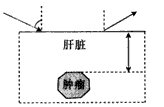 “B超”可用于探测人体内脏的病变情况,下图是超声波从肝脏表面入射,经折射与反射,最后从肝脏表面射出的示意图。超声波在人肝脏发生折射时 “B超”可用于探测人体内脏的病变情况,下图是超声波从肝脏表面入射,经折射与反射,最后从肝脏表面射出的示意图。超声波在人肝脏发生折射时