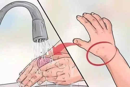 被蛇咬了怎么急救